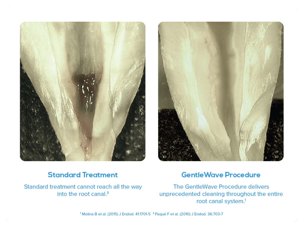 View of what's left over from a standard vs. GentleWave root canal treatment