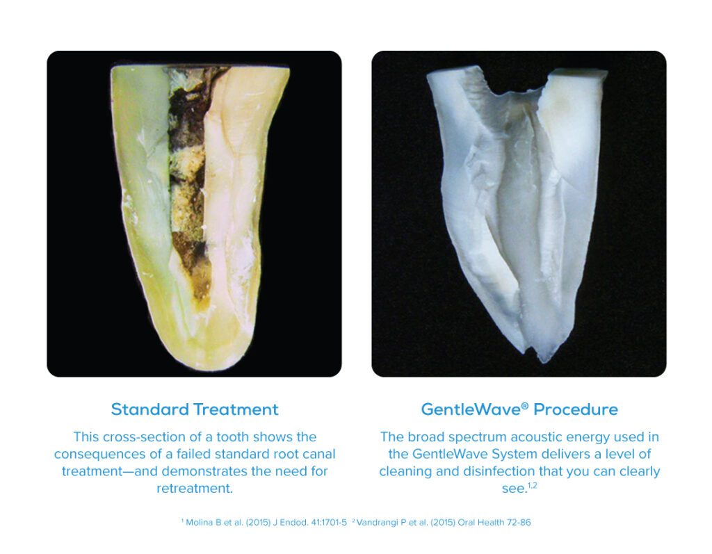 Comparing a tooth with a Standard vs. GentleWave root canal.